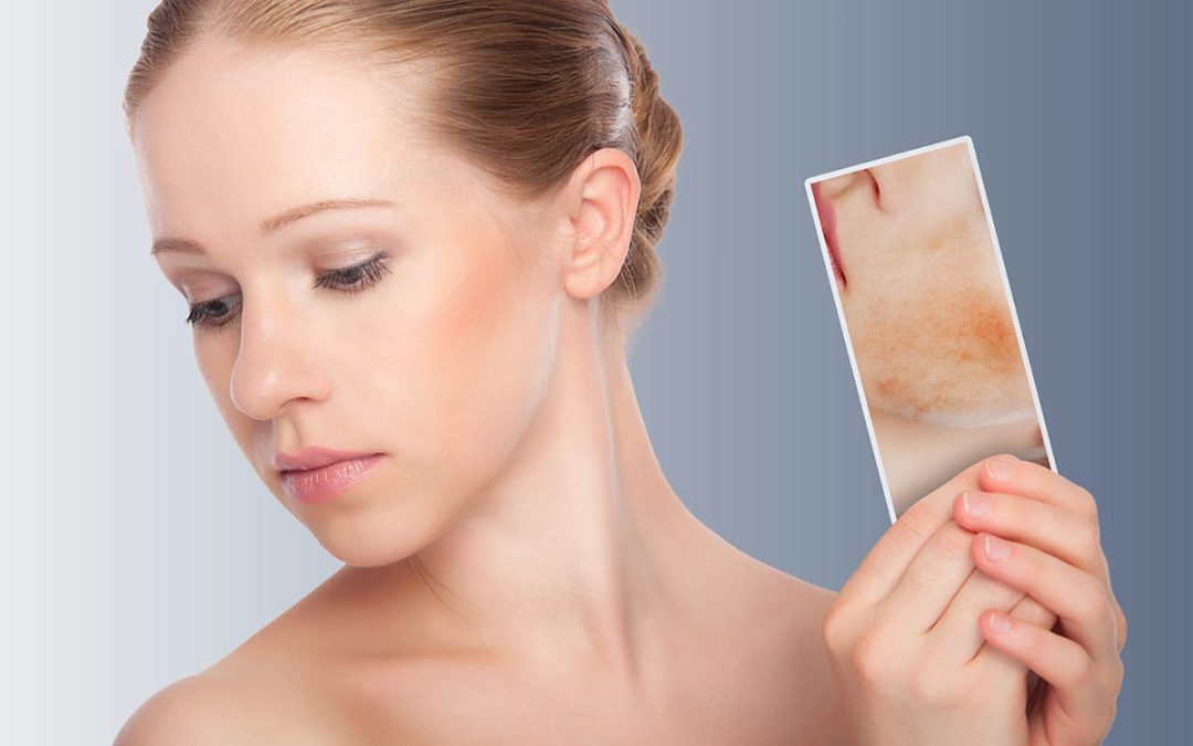 Rosacea del Viso e Couperose: cause e (soprattutto) rimedi efficaci